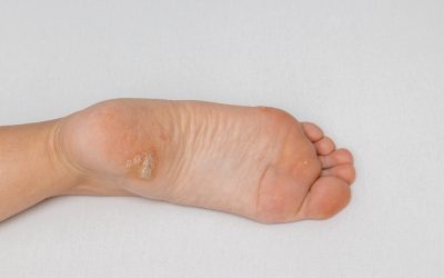¿Qué es el papiloma plantar y cuándo acudir al podólogo?